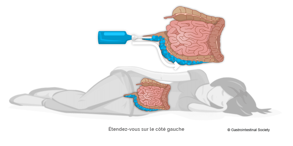 Colite ulcéreuse - Société gastro-intestinale | www.mauxdeventre.org