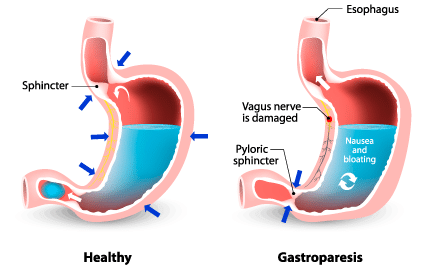diabetic gastroparesis cause of death)