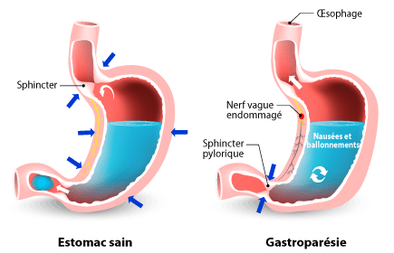 Gastroparésie - Société gastro-intestinale | www.mauxdeventre.org