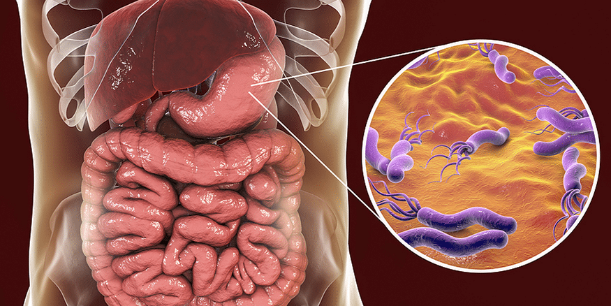 Helicobacter pylori | Gastrointestinal Society